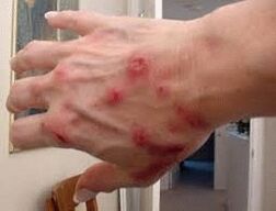 Papule na koži s helminthiasis
