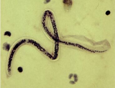 Bancroftova filarija